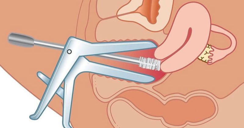 Viêm phúc mạc tiểu khung (Ảnh: Sưu tầm Internet)