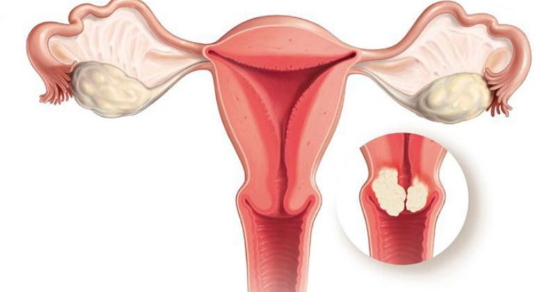 Nhiễm trùng toàn bộ tử cung sau sinh ảnh hưởng tới sức khỏe (Ảnh: Sưu tầm Internet)