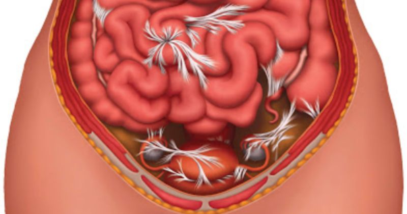 Viêm phúc mạc tiểu khung toàn bộ (Ảnh: Sưu tầm Internet)
