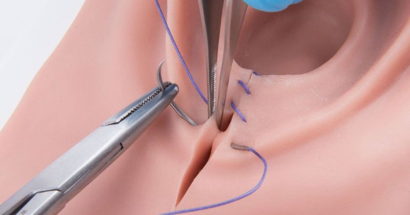 Nhiễm trùng vết rạch tầng sinh môn sau sinh (Ảnh: Sưu tầm Internet)