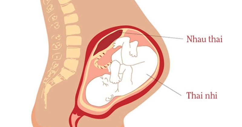 Nhiễm khuẩn vết mổ có thể là do bác sĩ lấy không hết nhau và màng(Ảnh: Sưu tầm Internet)