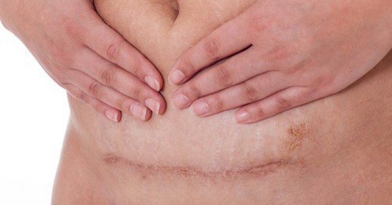 Nhiễm khuẩn vết thương có thể khiến mẹ bị nhiễm trùng máu (Ảnh: Sưu tầm Internet)