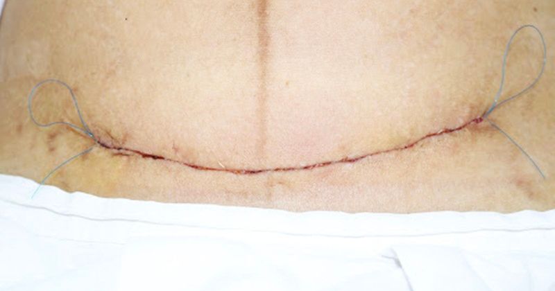 Khi mẹ bị nhiễm trùng vết mổ cơ thể sẽ bị sốt lên đến 38 độ C (Ảnh: Sưu tầm Internet)