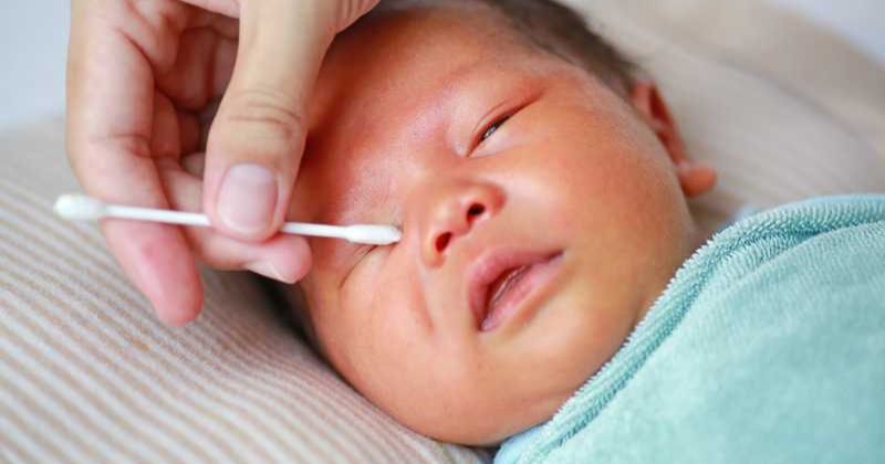 Trẻ sơ sinh bị đau mắt thường do virus Adenovirus. (Ảnh: Sưu tầm Internet)