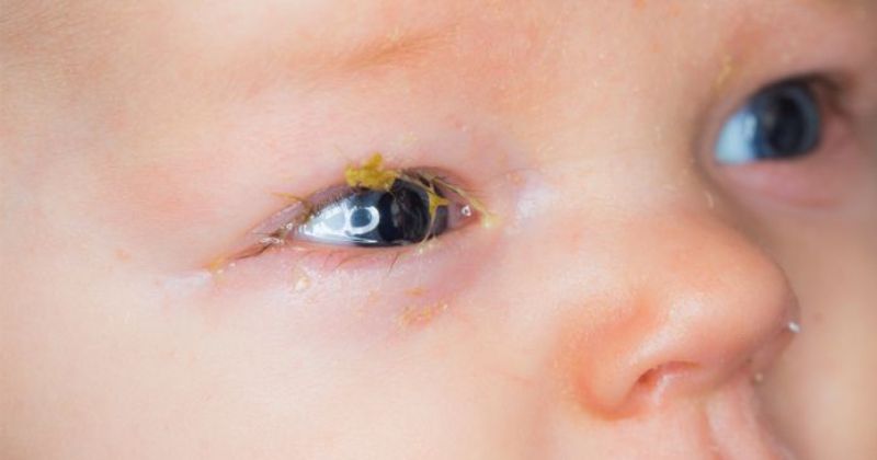 Nhỏ sữa mẹ vào mắt trẻ sơ sinh cực kỳ nguy hiểm. (Ảnh: Sưu tầm Internet)