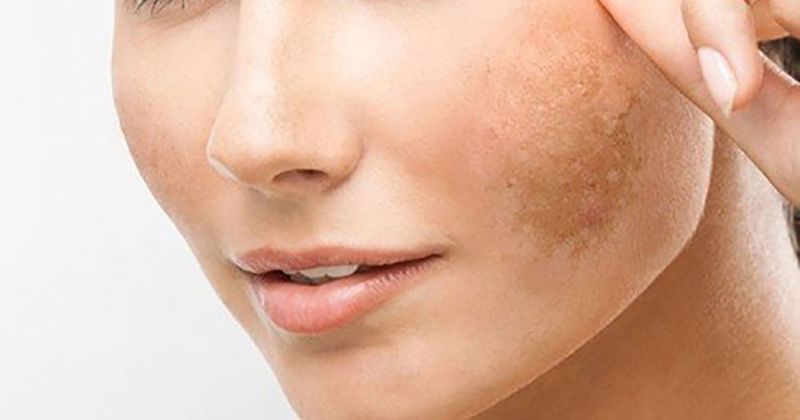 Nám da do thay đổi sắc tố là tình trạng hay gặp ở mẹ sau sinh (Ảnh: Sưu tầm Internet)