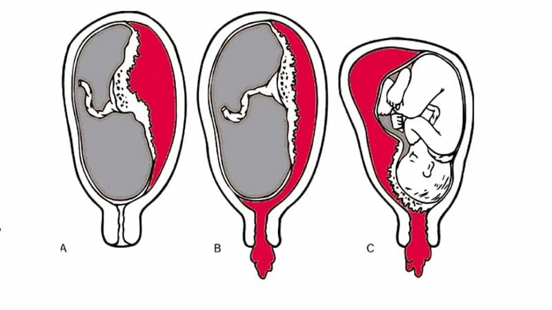 Mô phỏng nhau bong non trong thai kỳ. (Ảnh: Internet)