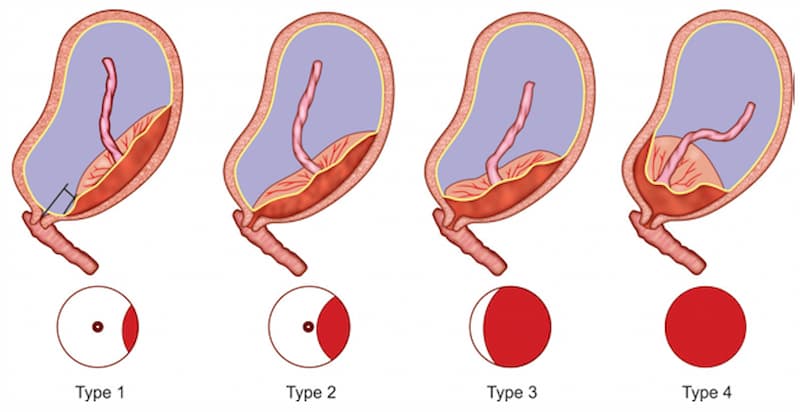 Nhau tiền đạo là 1 trong các nguyên nhân ra máu sau quan hệ. (Ảnh: Internet)
