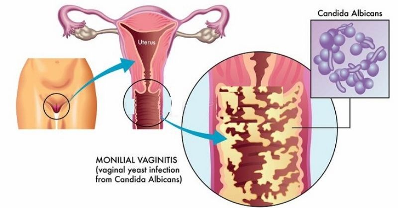Quan hệ sớm gây ra tình trạng viêm nhiễm âm đạo (Ảnh: Sưu tầm Internet)