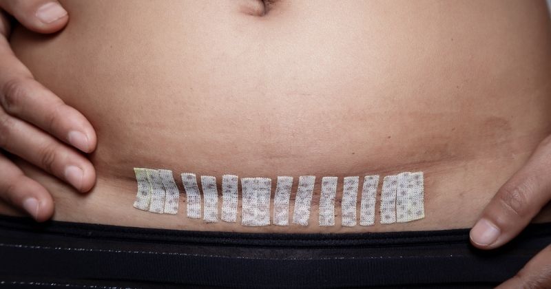 Quan hệ sau sinh mổ sớm có thể làm rách vết mổ (Ảnh: Sưu tầm Internet)