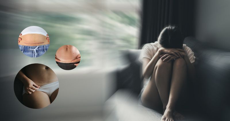 Mẹ sau sinh mổ bị stress phải làm sao (Ảnh: Sưu tầm Internet)