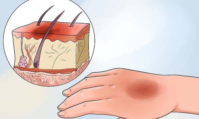 Trẻ 1 tuổi bị bỏng nước sôi cấp độ 1 (Nguồn: Sưu tầm Internet)