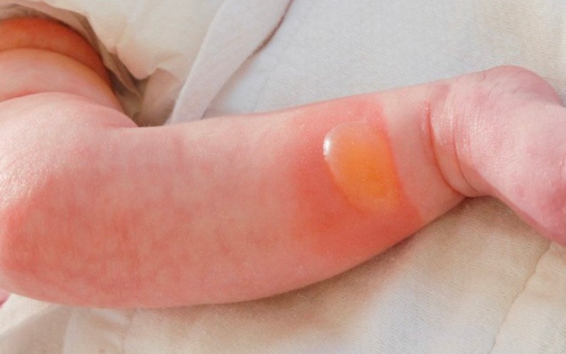 Trẻ bị bỏng hơn 8% được coi là bị bỏng cấp độ 3 (Ảnh: Sưu tầm internet)