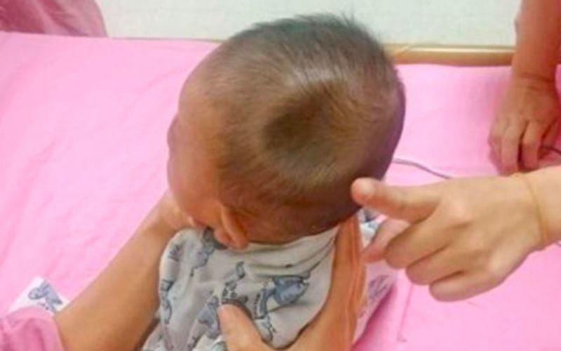 Đầu bé bị lõm vào trong là biểu hiện của vỡ xương sọ (Ảnh: Sưu tầm internet)