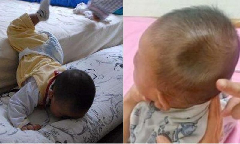 Các dạng chấn thương vùng đầu và vùng não khi trẻ bị ngã (Nguồn: Sưu tầm Internet)