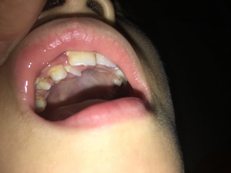 Răng vĩnh viễn có thể bị mọc lệch. (Ảnh: Internet)