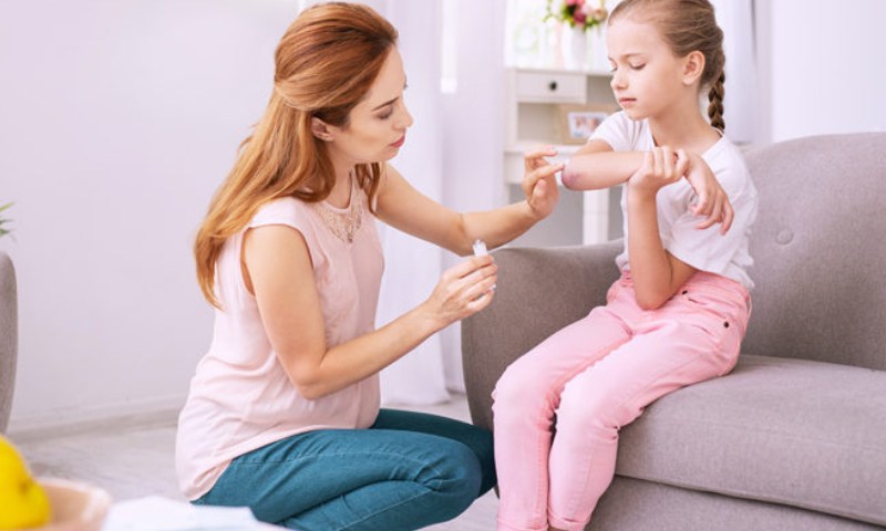 Cần làm gì để chăm sóc vết bỏng cấp 1 và cấp 2 cho trẻ ngay tại nhà? (Nguồn: Sưu tầm Internet)