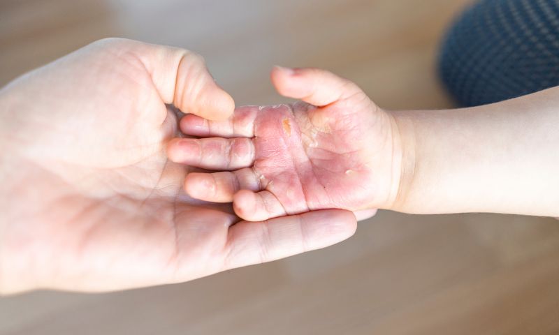 Sơ cứu bỏng đúng cách giúp hạn chế nguy cơ tăng nặng. (Ảnh: Nguồn Internet)