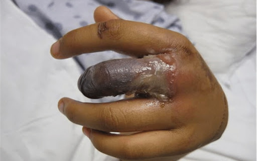 Các triệu chứng khi bị bỏng điện (Ảnh: sưu tầm Internet)