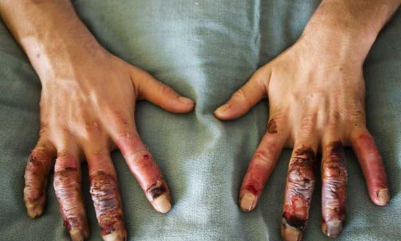 Mức độ nguy hiểm khi trẻ bị bỏng độ 3 (Nguồn: Sưu tầm Internet)