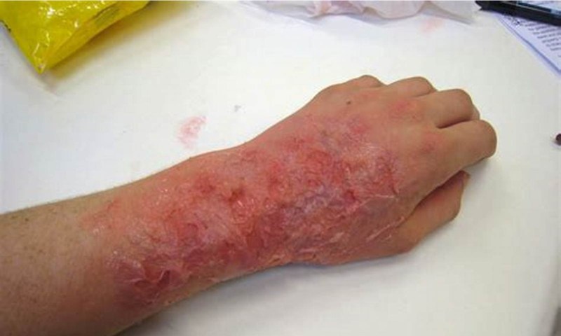 Phân loại tình trạng của bỏng cấp độ 3 - Vết bỏng nông (Nguồn: Sưu tầm internet)