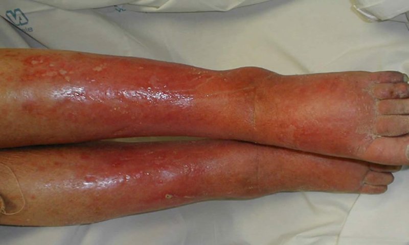 Phân loại tình trạng của bỏng cấp độ 3 - Vết bỏng sâu (Nguồn: Sưu tầm internet)