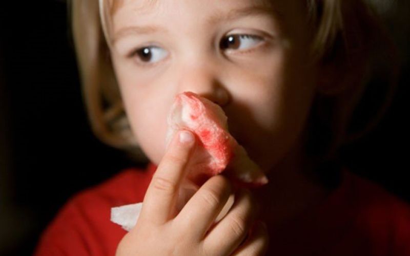 Xác định vị trí mũi bị chảy máu để tiến hành cầm máu cho trẻ kịp thời (Nguồn: Sưu tầm Internet)