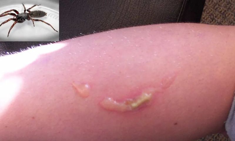 Trẻ bị nhện cắn cần xử lý đúng cách. (Ảnh: Nguồn Internet)