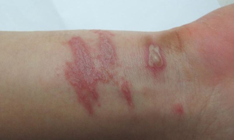 Kiến ba khoang gây nên tình trạng viêm loét da. (Ảnh: Nguồn Internet)