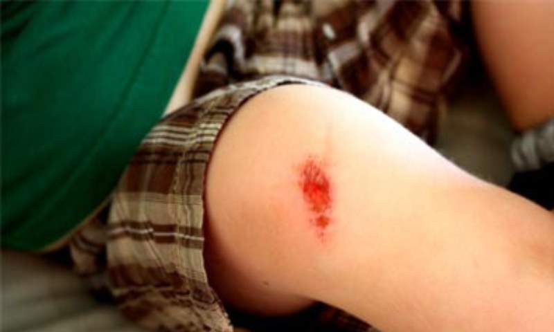 Cần làm gì khi trẻ bị té ngã chảy máu? (Nguồn: Sưu tầm Internet)