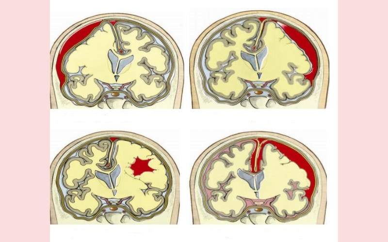 Tụ máu não là tình trạng xung huyết gây chảy máu và sưng bên trong não (Ảnh: Sưu tầm Internet)