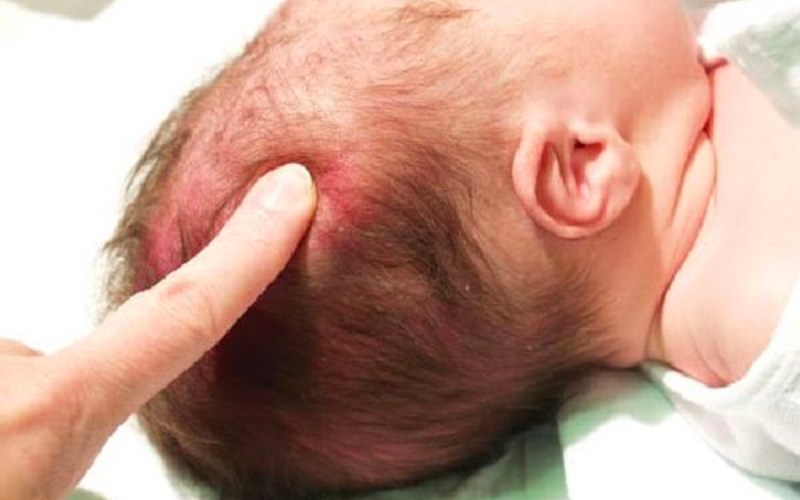 Tình trạng gãy xương sọ do ngã là tình trạng rất nguy hiểm (Ảnh: Sưu tầm Internet)