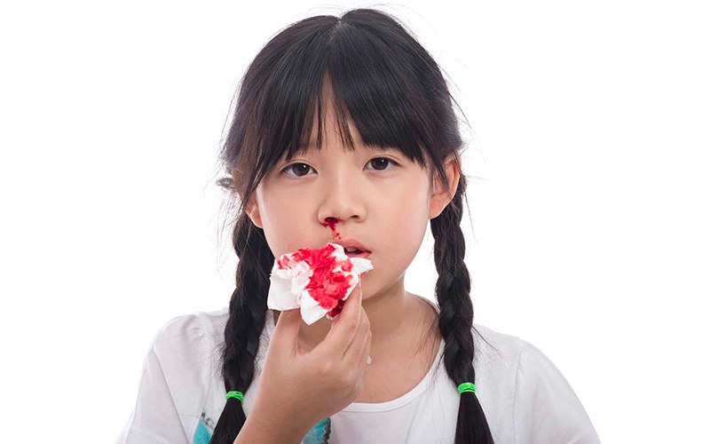 Chảy máu mắt, mũi, miệng là biểu hiện nghiêm trọng cần được điều trị ngay (Ảnh: Sưu tầm internet)