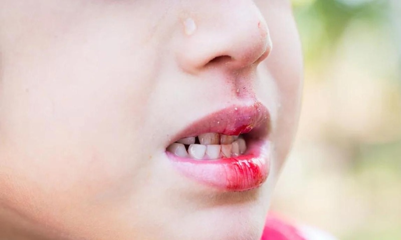 Chăm sóc trẻ như thế nào khi trẻ bị dập môi? Nguồn: Sưu tầm Internet)