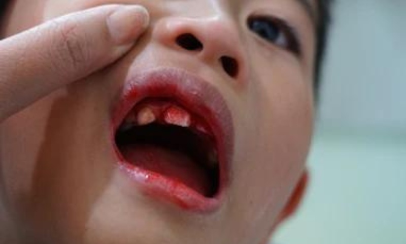 Những biểu hiện của trẻ bị ngã đập mặt xuống đất bị sứt và gãy răng Nguồn: Sưu tầm Internet)