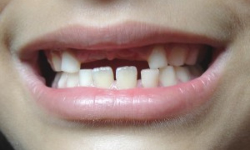 Xử lý các vết thương khi ngã đập mặt sứt hoặc gãy răng như thế nào? (Nguồn: Sưu tầm Internet)