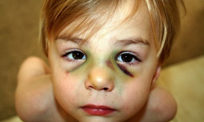 Biểu hiện khi trẻ bị ngã đập mặt xuống đất bị chảy máu mũi (Nguồn: Sưu tầm Internet)