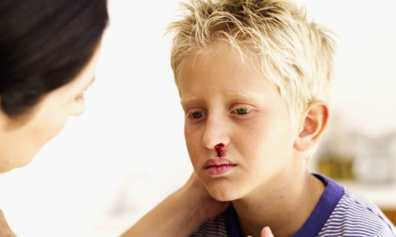 Hướng dẫn chăm sóc trẻ bị ngã đập mặt dập mũi (Nguồn: Sưu tầm Internet)