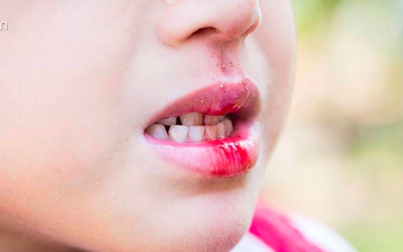 Trước hết, mẹ cầm máu cho bé để vết thương ngưng chảy máu (Ảnh: Sưu tầm trên Internet)