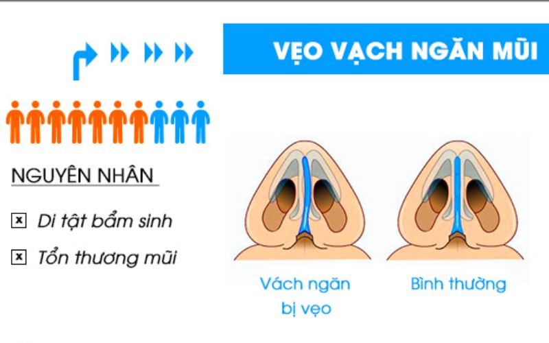 Phần sụn ngăn cách mũi bị di chuyển sang một bên dẫn đến tình trạng lệch vách ngăn mũi (Ảnh: Sưu tầm Internet)
