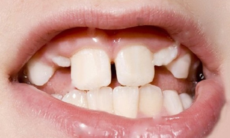 Trẻ bị đứt dây chằng môi trên khi bị té ngã có nguy hiểm hay không (Nguồn: Sưu tầm Internet)