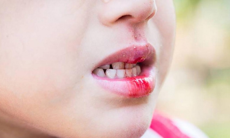 Cầm máu cho trẻ khi trẻ bị ngã đứt dây chằng môi trên và chảy máu (Nguồn: Sưu tầm Internet)