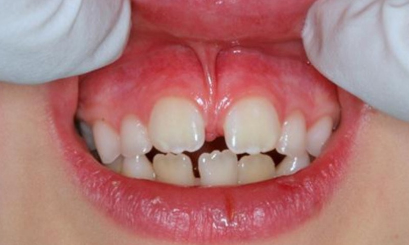 Trẻ bị đứt dây chằng môi trên bao lâu thì khỏi? (Nguồn: Sưu tầm Internet)