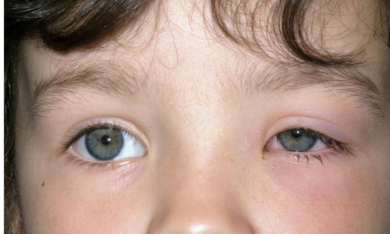 Trẻ bị ngã sưng mắt phải làm sao? Những dấu hiệu để biết trẻ bị chấn thương mắt (Nguồn: Sưu tầm Internet)