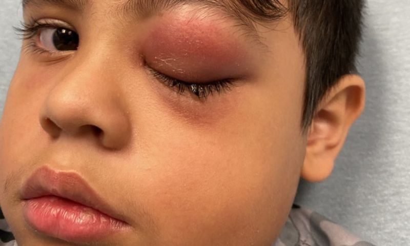 Cần xử lý khi hoá chất dính vào mắt trẻ bị ngã sưng mắt phải làm sao? (Nguồn: Sưu tầm Internet)