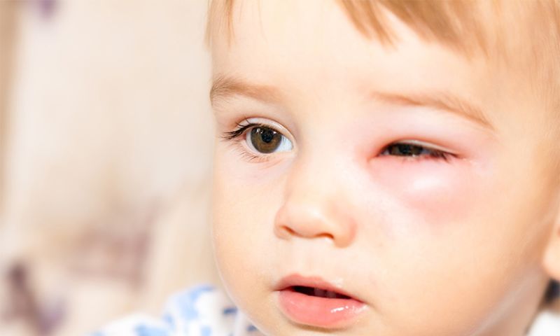 Hướng dẫn cách xử lý khi trẻ bị vật nhọn dài đâm vào mắt (Nguồn: Sưu tầm Internet)