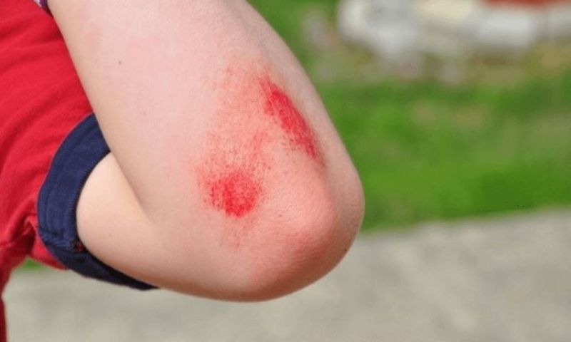 Các vết xước ngoài da không quá nguy hiểm, nhanh lành. (Ảnh: Nguồn Internet)