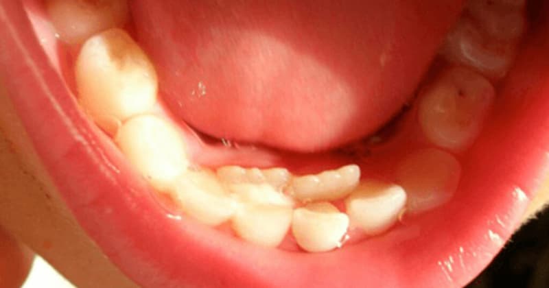 Nguyên nhân bé chậm mọc răng. (Ảnh: sưu tầm internet)