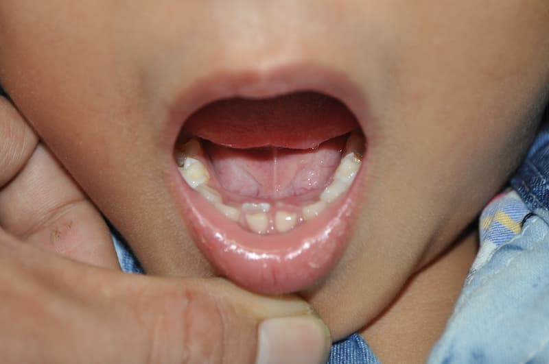 Ba mẹ phải làm gì khi con mọc răng quá chậm. (Ảnh: Sưu tầm internet)
