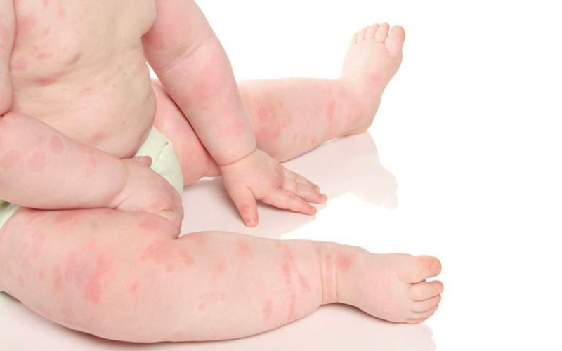 Chủ quan vết cắn côn trùng của bé có thể khiến vết thương phát triển nặng hơn (Ảnh: Sưu tầm internet)